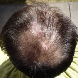 Over 40 and Balding–You’re Finished
